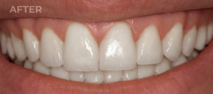 An UpWhiten client's teeth before and after one session — result 4 of 6