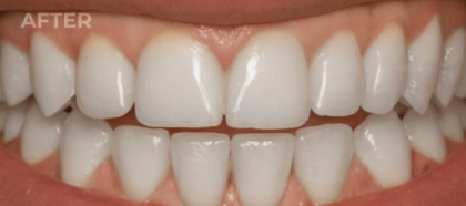 An UpWhiten client's teeth before and after one session — result 1 of 6