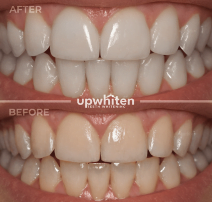 Before and after comparison of teeth whitening treatment in Ottawa, showcasing a significant improvement in tooth color and brightness.
