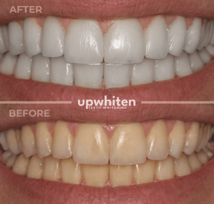 Before and after comparison of teeth whitening treatment in Ottawa showing a noticeable difference in tooth color.